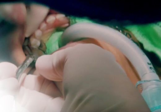 Belehalt a foghúzásba a 9 éves kisfiú